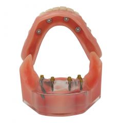 ERA Implant Model
