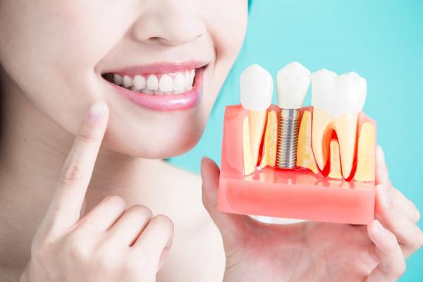 How Does Dental Implant Surgery Work?