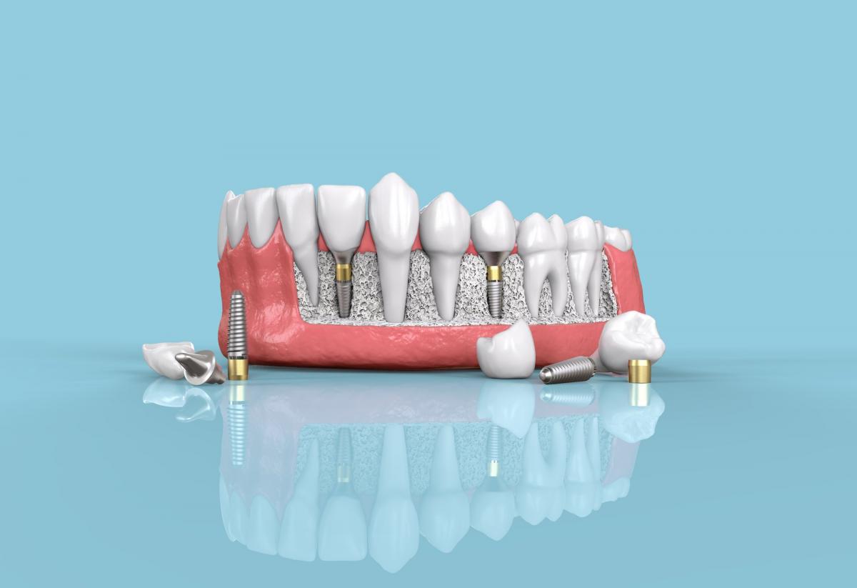 The Ultimate Guide to Affordable Dental Solutions for Dental Implants