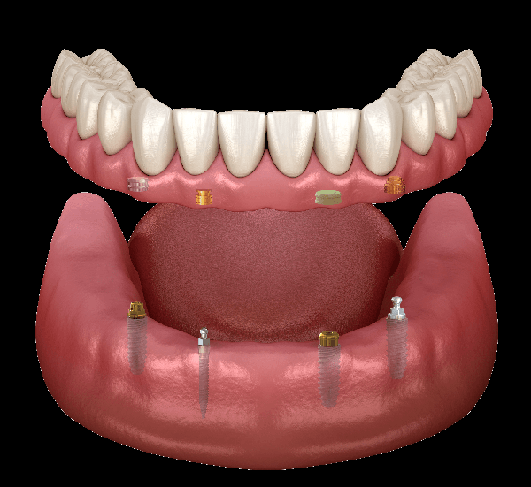 A Brief History of Dental Implants