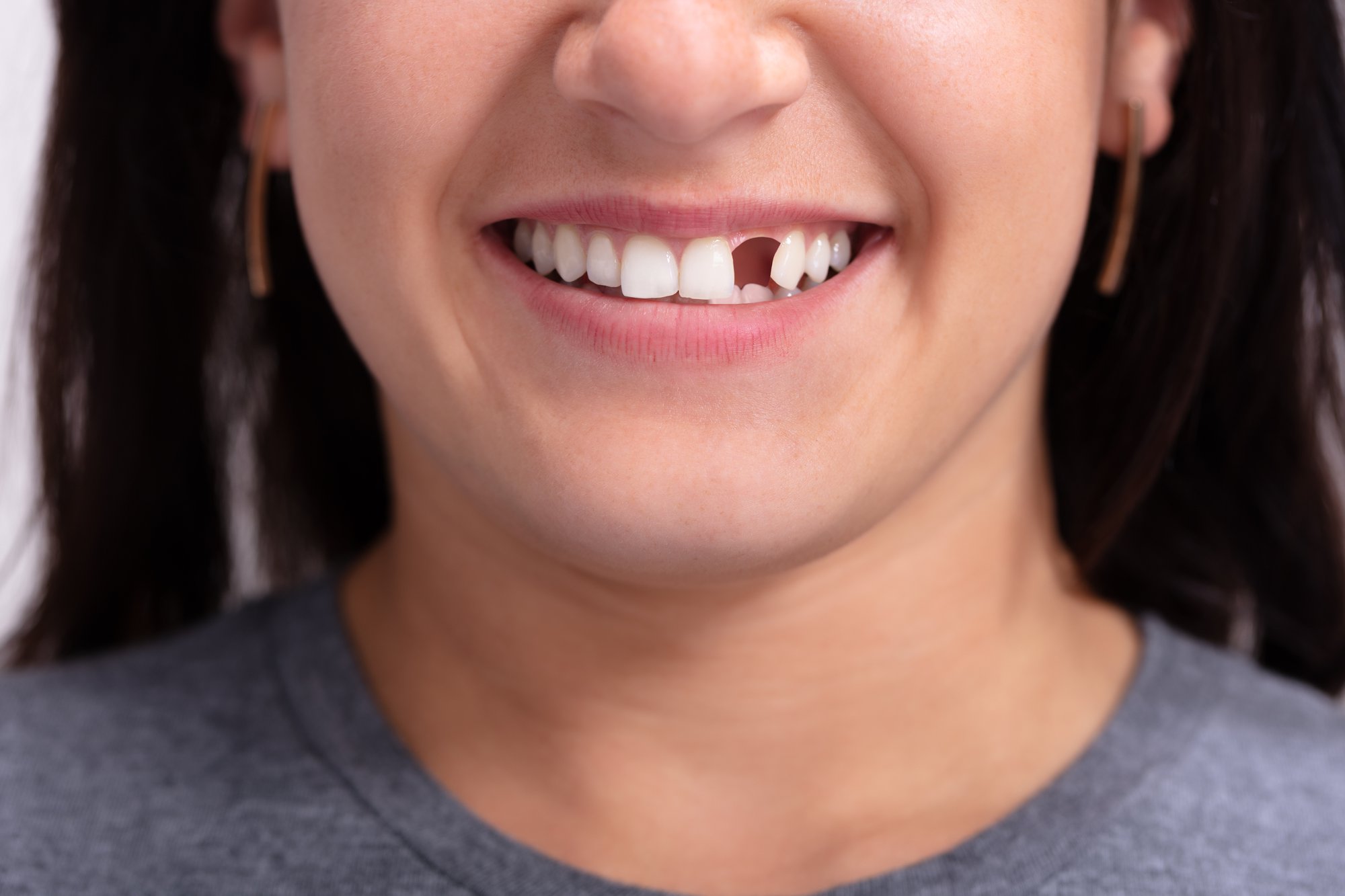 Lost Your Tooth? All Is Not Lost: Hope After Dental Extraction