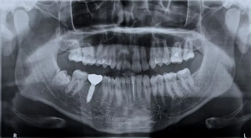 first x-ray used for dentistry, now evolved to the modern panoramic x-ray used in restorative dentistry procedures